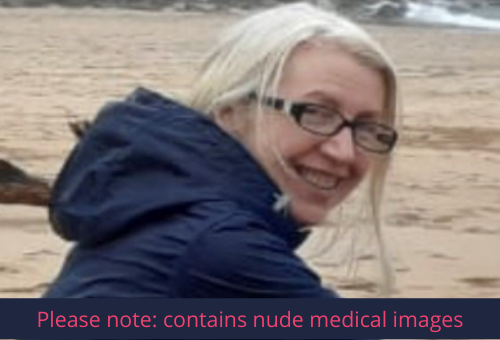 Contains nude medical images